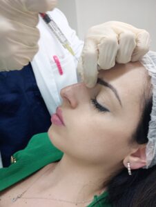 filler acido ialuronico