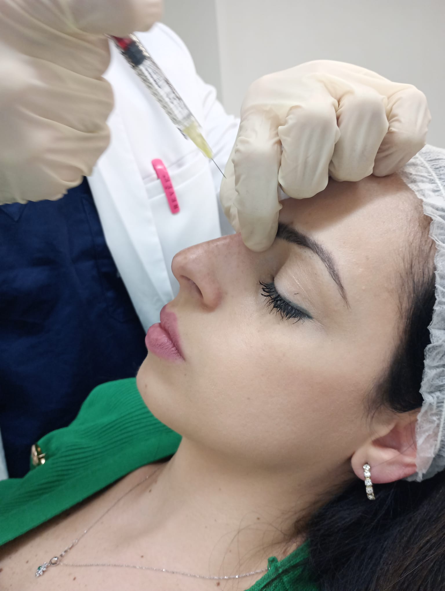filler acido ialuronico