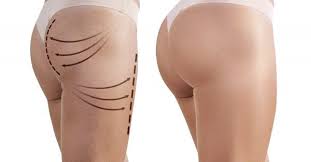 gluteoplastica