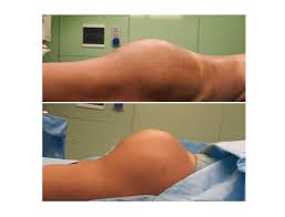 gluteoplastica