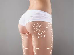 liposuzione liposcultura