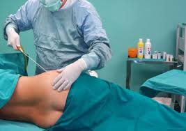 liposuzione liposcultura