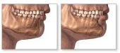 mentoplastica