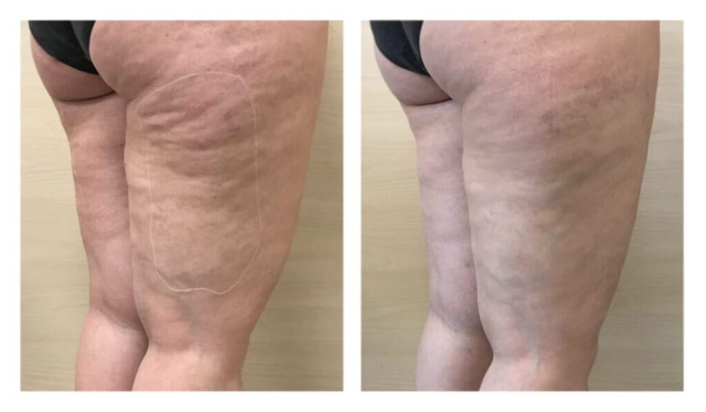 mesoterapia capillare