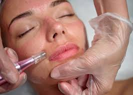 microneedling viso
