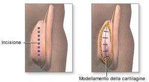 otoplastica