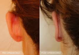 otoplastica