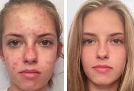 peeling chimico viso