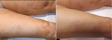 scleroterapia laser