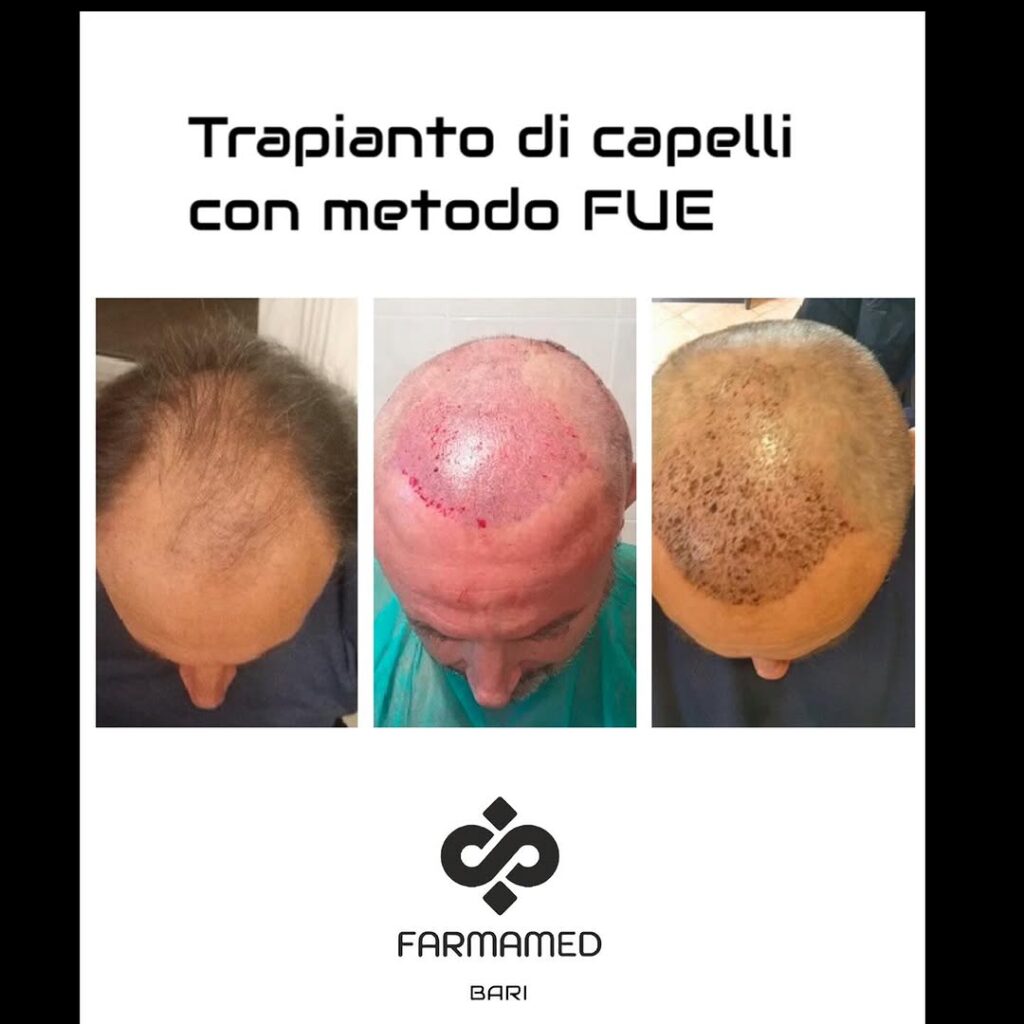 trapianto capelli FUE