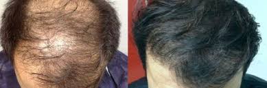 trapianto capelli FUE