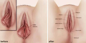 vaginoplastica