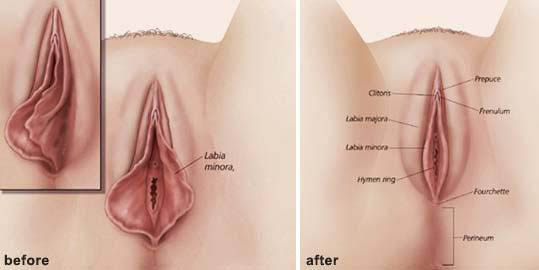 vaginoplastica